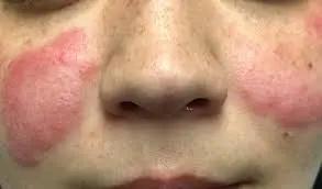Nystatine sur le visage