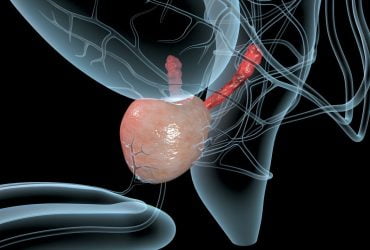 What-is-Enlarged-Prostate-and-When-is-Surgery-Necessary