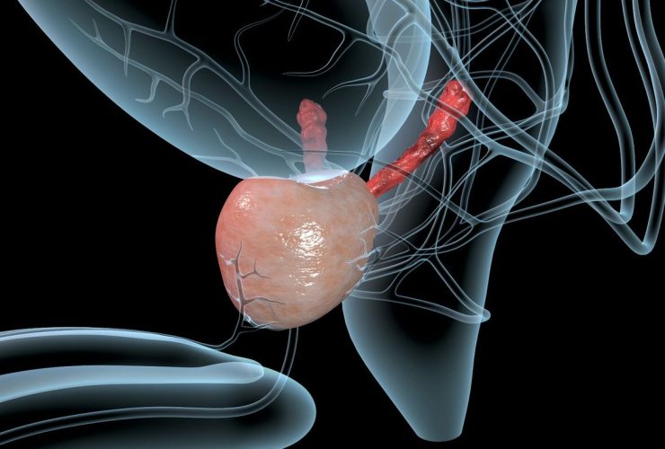What-is-Enlarged-Prostate-and-When-is-Surgery-Necessary