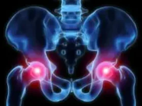 Existem alongamentos que você pode fazer para osteoartrite do quadril?