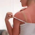 queimadura solar